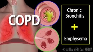 COPD  Chronic Obstructive Pulmonary Disease Animation [upl. by Salomie]