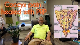 Coccyx pain healed with PRP [upl. by Ymmaj300]