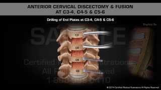 Understanding Cervical Ectropion  Cervical Erosion [upl. by Anilos]