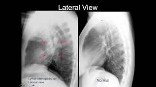 Chest Xray Cases 2 [upl. by Merla43]