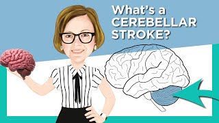 Cerebellar Stroke [upl. by Seed]