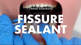 Placement of a Fissure Sealant [upl. by Lachus]