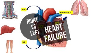 Heart Failure  Right sided vs Left sided  Cor Pulmonale  ASPIRE MDS [upl. by Inge630]