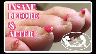 Pedicure Tutorial Elderly Thick Toenails Growing Up Transformation [upl. by Ennaeerb]