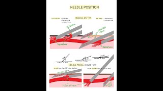 Venipuncture  How to Position a Needle [upl. by Anaahs]