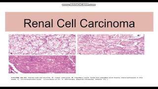 Renal cell carcinoma TypesGeneticsMorphology [upl. by Morty283]