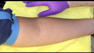 Tips For Locating Difficult Veins [upl. by Brigette541]