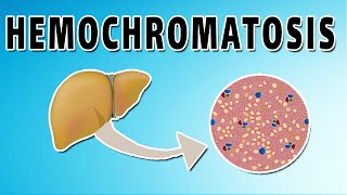 Hemochromatosis [upl. by Torbert999]