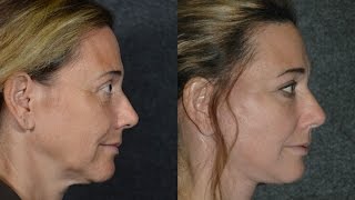 Facelift Surgery SLift on 50YearOld Woman  Ponytail Technique Facelift ponytailfacelift [upl. by Umeh]